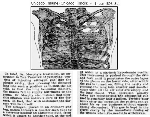 Dr J.B. Murphy's postulated a cure for tuberculosis